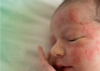 Espinhas na pele do bebê? Entenda o que é acne neonatal